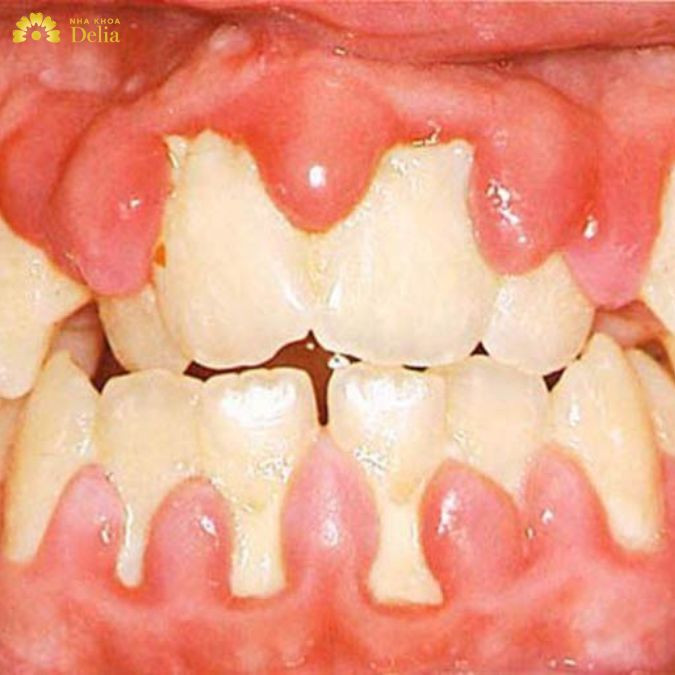 một số trường hợp viêm lợi phì đại còn xuất phát từ tác dụng phụ của thuốc điều trị