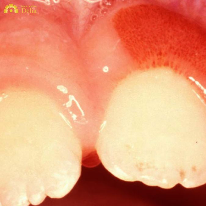chế độ ăn uống và thói quen sinh hoạt cũng đóng vai trò quan trọng trong việc gia tăng nguy cơ mắc viêm lợi phì đại