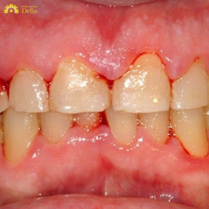 việc chăm sóc răng miệng và điều chỉnh chế độ ăn uống đóng vai trò quan trọng trong việc hỗ trợ điều trị và ngăn ngừa bệnh tiến triển