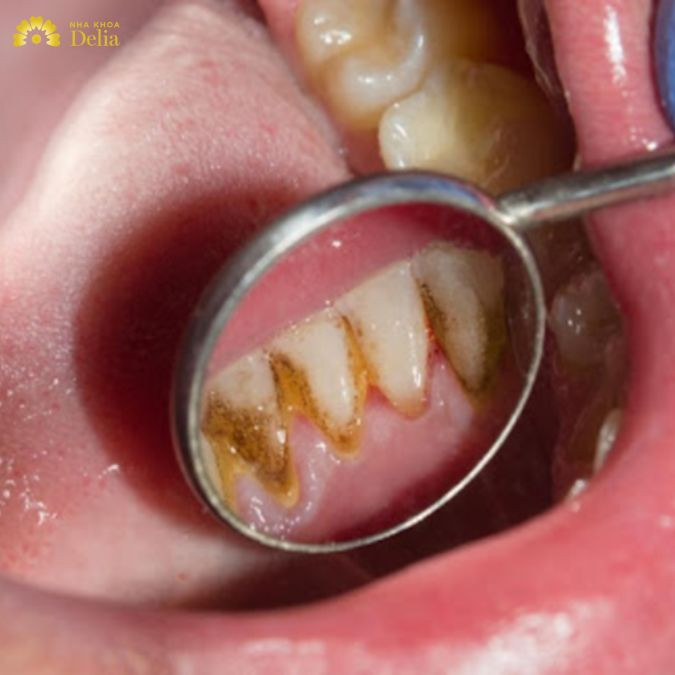 Dấu hiệu nhận biết viêm lợi sưng má