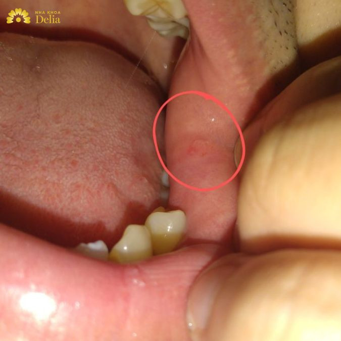 Nếu không được điều trị kịp thời, viêm lợi có thể tiến triển thành viêm nha chu với những triệu chứng nghiêm trọng hơn
