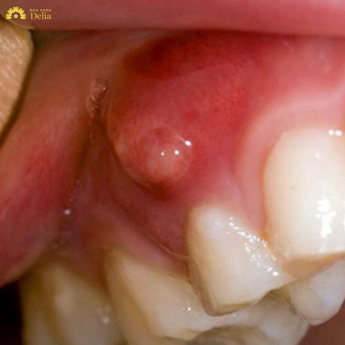 Vi khuẩn từ ổ áp xe xâm nhập vào máu, tấn công van tim, gây viêm nhiễm
