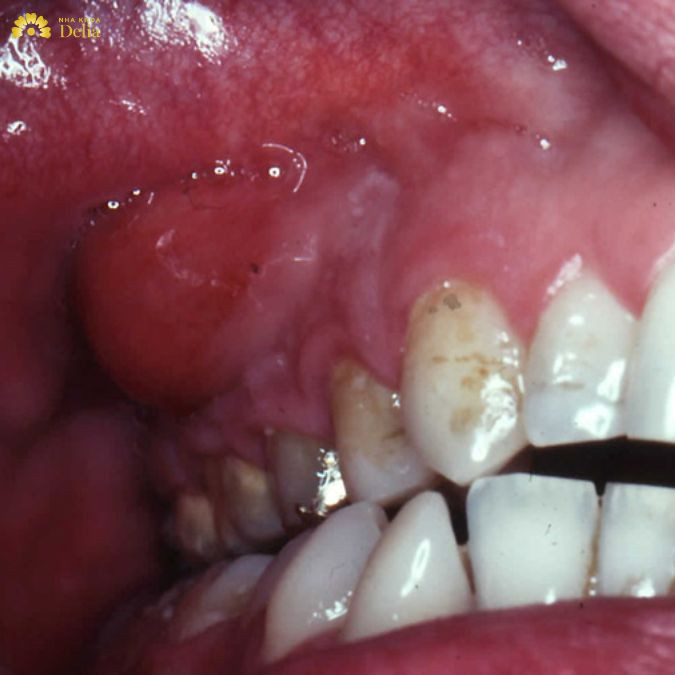 Trong một số trường hợp, áp xe có thể vỡ, mủ chảy ra ngoài miệng