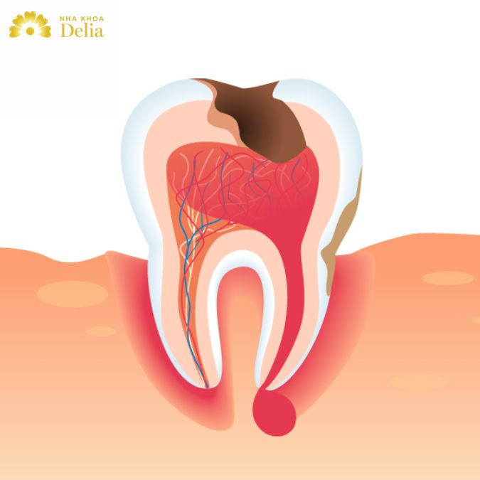 Chân răng bị sưng, dễ dàng nhìn thấy túi mủ bằng mắt thường, khi đè vào khả năng mủ vỡ hoặc đau đớn