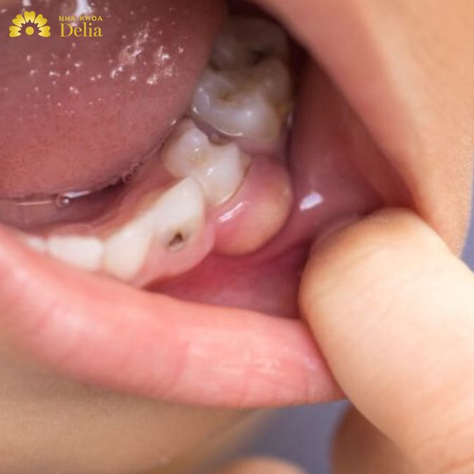 Những mảng bám tích tụ dày đặc do vệ sinh răng miệng không đúng cách đã tạo ra một trường cho vi khuẩn phát triển