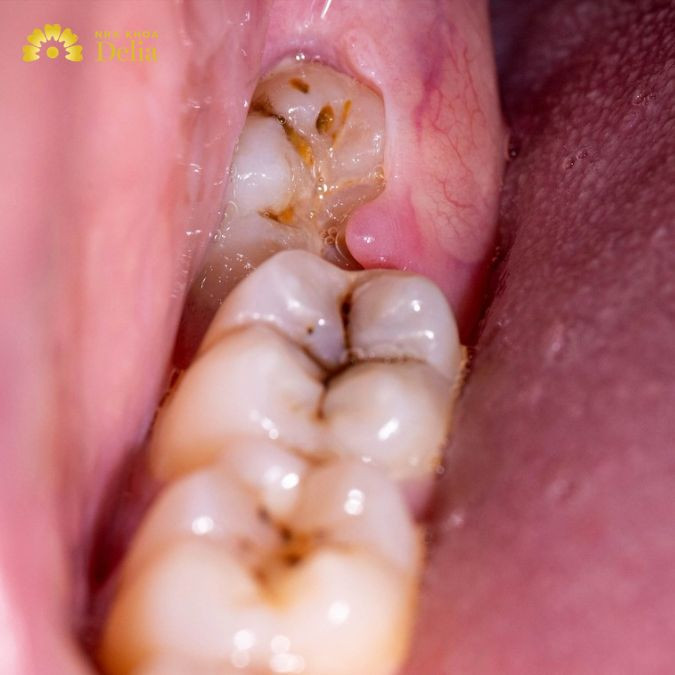 xe răng khôn là tình trạng sâu, viêm tủy, sưng mủ ở vị trí răng khôn