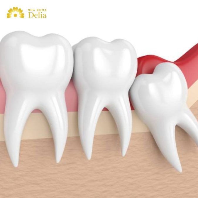 Vi khuẩn dễ dàng tích tụ, tấn công và hình thành ổ mủ tại chân răng