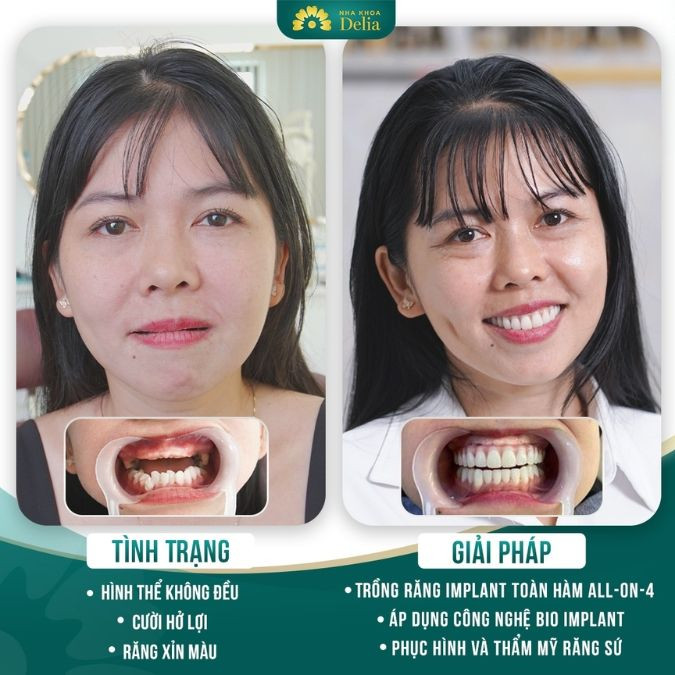 Răng Implant có tuổi thọ cao, có thể tồn tại suốt đời nếu có phương pháp chăm sóc tốt