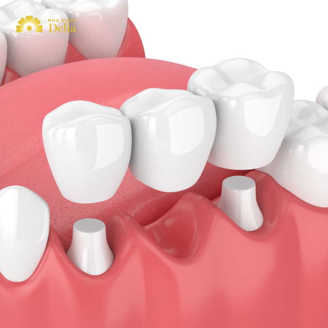 Bắc cầu răng hàm là phương pháp phục hình răng sử dụng một hoặc nhiều răng giả được nối liền với các mão sứ