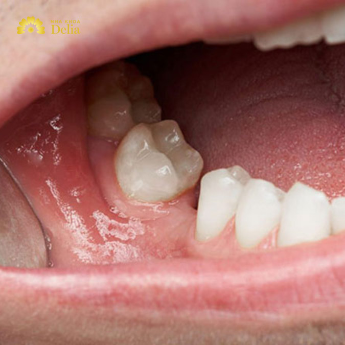 Những người mất ít răng có thể làm cầu răng sứ