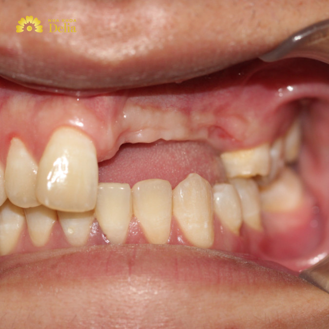 Người mất nhiều răng sẽ không thể thực hiện bắc cầu răng sứ