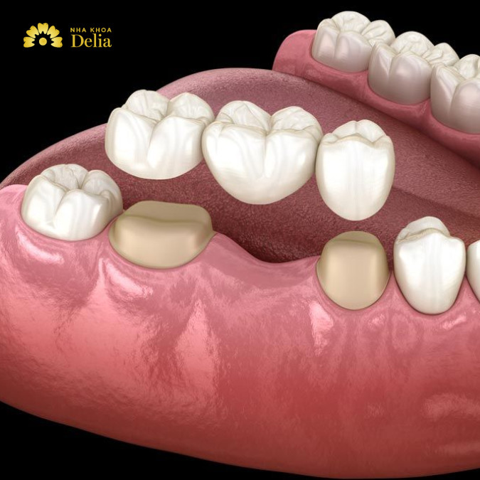 Cầu răng sứ sau khi chế tác thành công được lắp đặt trên trụ răng đã mài