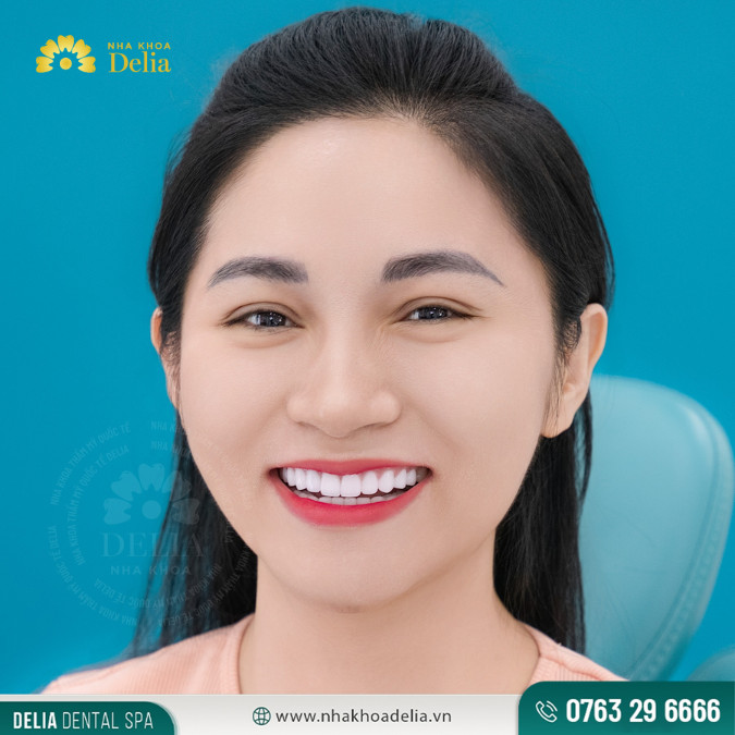 Bắc cầu răng hàm giúp khôi phục nụ cười đẹp thẩm mỹ, tăng cường sự tự tin khi giao tiếp