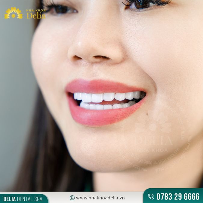 Dán sứ Veneer