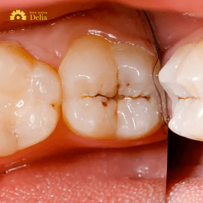 Các bệnh lý răng miệng nếu không được điều trị sẽ gây hôi miệng