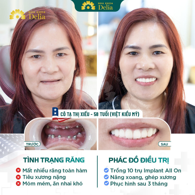 Trồng răng Implant đem lại khả năng ăn nhai như răng thật và tính thẩm mỹ cao