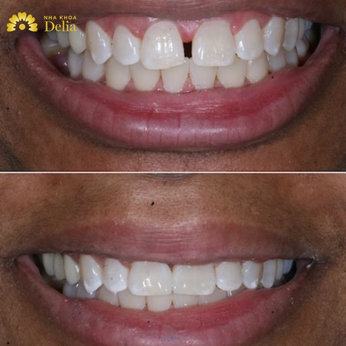 Dental fillings are also called dental fillings