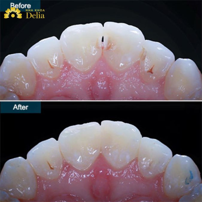 Dental fillings can only be maintained for a certain period of time and cannot be used forever