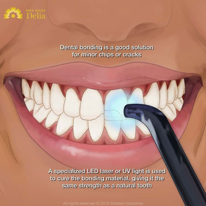 On the market today there are many materials used to fill teeth, the price of the materials will go hand in hand with the advantages they bring.
