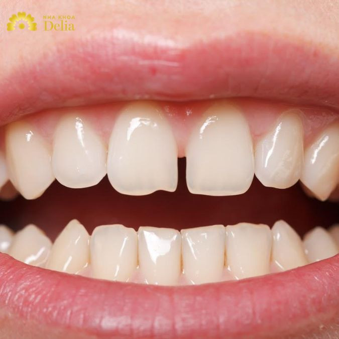 Slightly spaced teeth