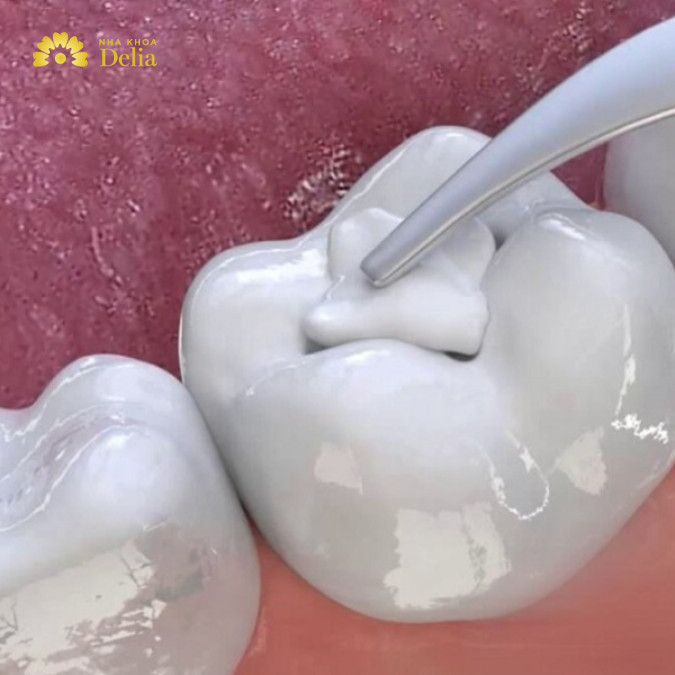 Composite cần được tạo hình lại để phù hợp với khớp cắn