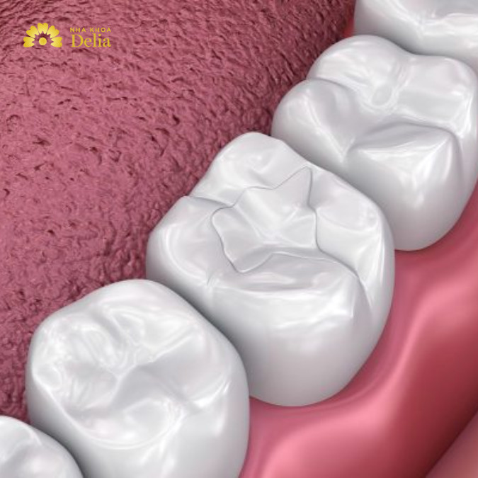Chất kết dính giúp composite và răng được dính chắc với nhau lâu dài hơn