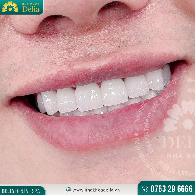Mỗi dáng gương mặt sẽ thích hợp với một kiểu dáng răng sứ