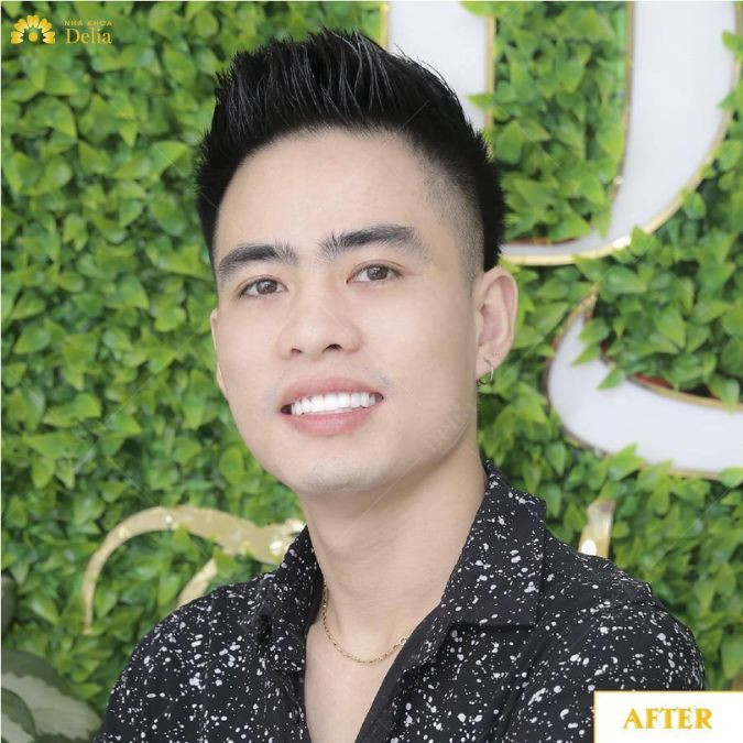 Sứ Ceramill