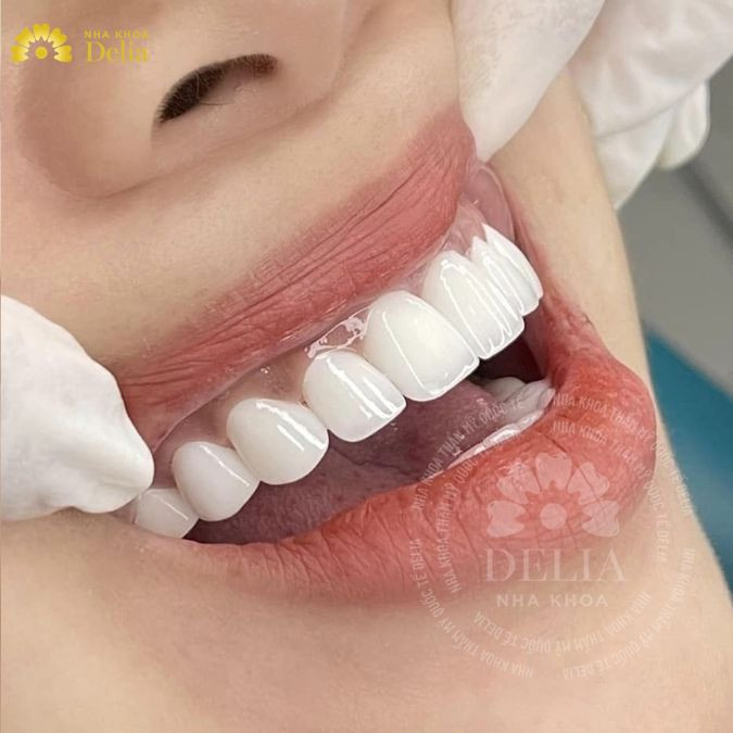 Bọc răng sứ là phương pháp phục hồi răng cố định bằng vật liệu sứ