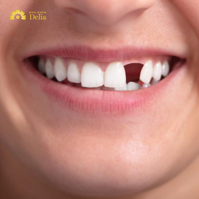Hàm giả bán phần tháo lắp phù hợp với những người mất từ một đến nhiều răng