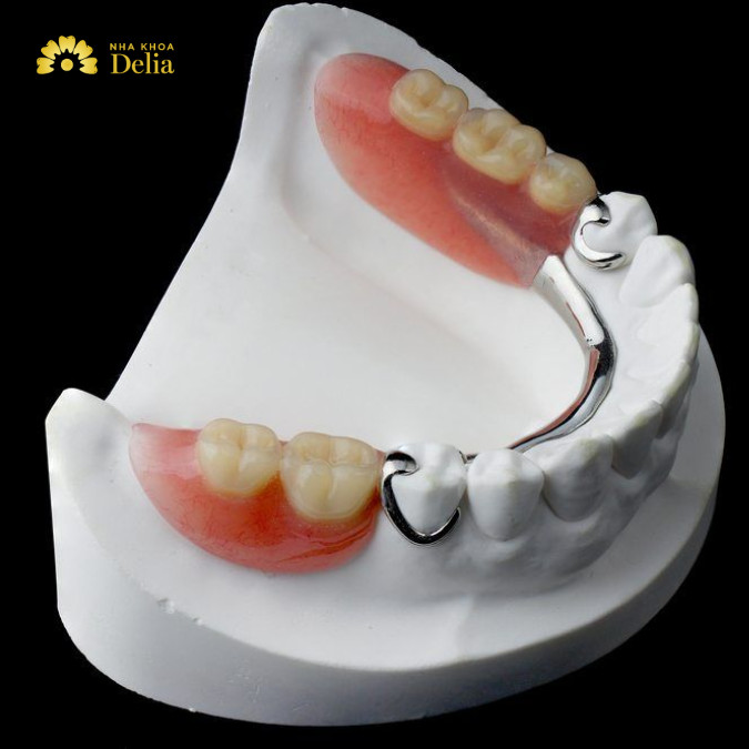 Hàm tháo lắp bán phần cần điều chỉnh thường xuyên
