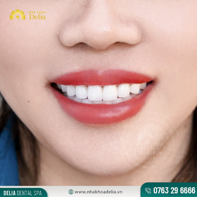 Một trong những lợi ích chính của kem đánh răng muối là khả năng ngăn ngừa sâu răng hiệu quả