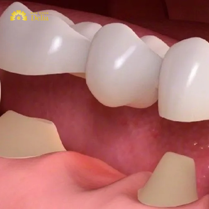 Làm cầu răng số 6 là phương pháp phục hình răng đã mất bằng cách mài răng số 5 và số 7 sau đó chụp mão sứ lên