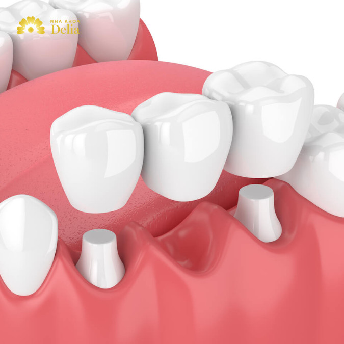Hai răng số 5 và số 7 cần được mài nhỏ để làm trụ vững chắc cho cả cầu răng