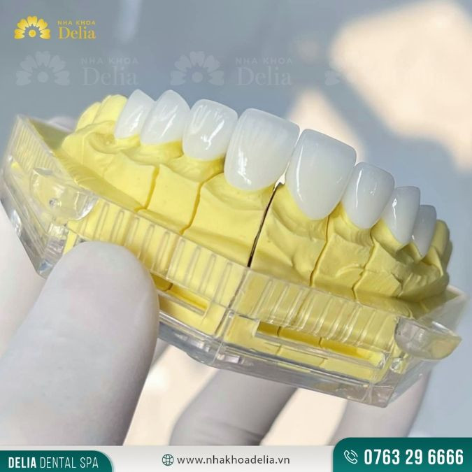 Lấy dấu răng để bác sĩ xác định hình dáng, kích thước của răng nhằm chế tác cầu răng chính xác hơn