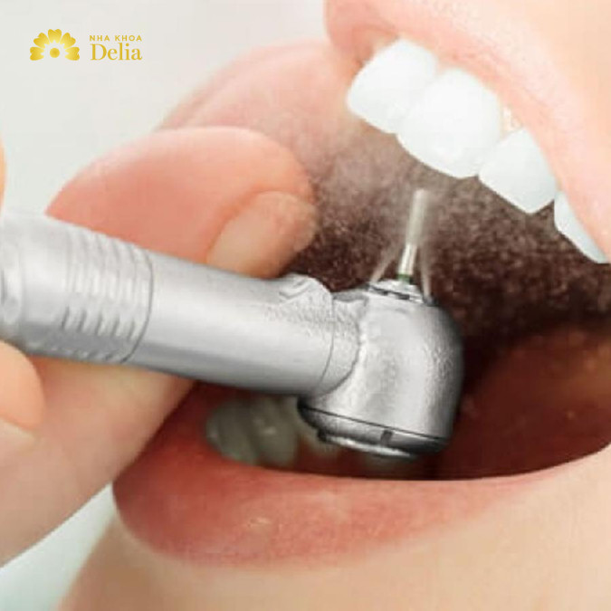Nhược điểm và rủi ro khi làm cầu răng số 6: cần mài răng thật