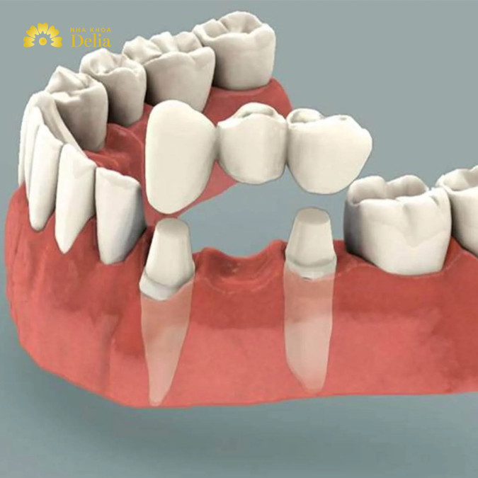 Bắc cầu răng sứ là phương pháp phục hình răng đã mất, phù hợp với người mất một hoặc một số răng.