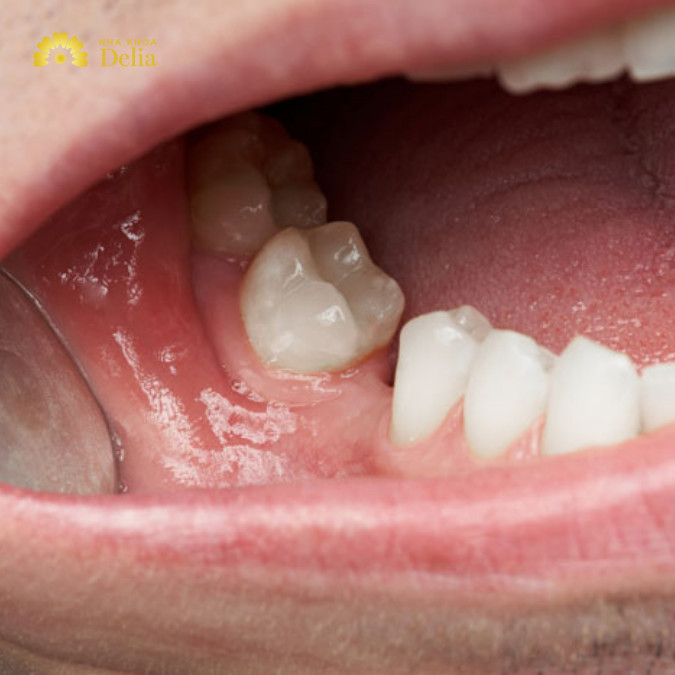 Hàm giả tháo lắp không hề ngăn ngừa được quá trình tiêu xương