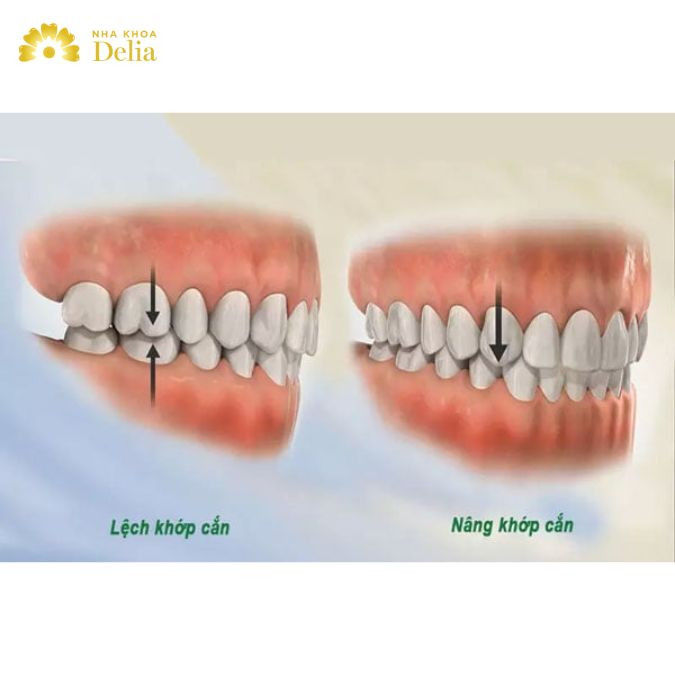 Bác sĩ khi đó sẽ sử dụng một loại khí cụ với mục đích nâng khớp trên bề mặt của răng cửa mặt sau hoặc răng hàm