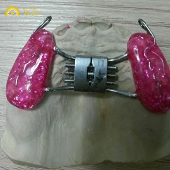 Sử dụng máng nâng khớp cắn