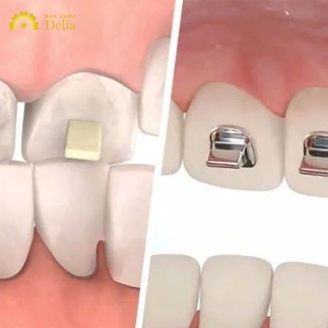 Thông thường thời gian nâng khớp cắn thường từ 3 tháng cho tới 12 tháng