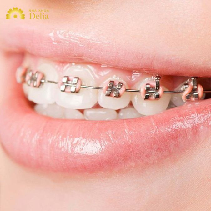 Đặc biệt nếu không nâng khớp cắn vấn đề này sẽ khiến khớp cắn tổn thương bởi mắc cài