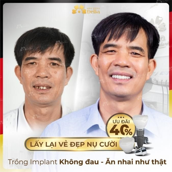 Tặng bố gói trồng răng Implant nếu bố bị mất một hoặc nhiều răng, giúp bố ăn nhai tốt hơn.
