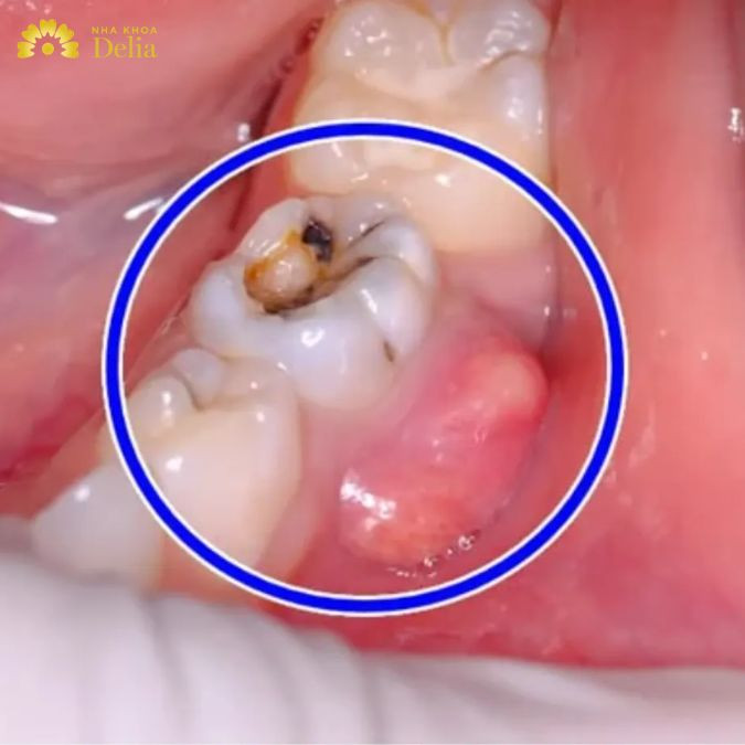 Nhiễm trùng răng sâu