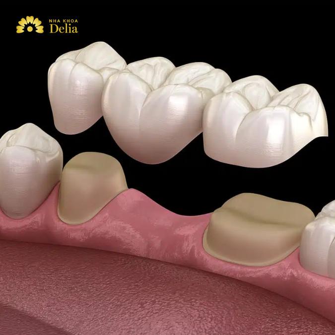 Làm cầu răng sẽ sử dụng 2 mão sứ để chụp lên răng giả đã mài và răng giả ở giữa để phục hình răng đã mất