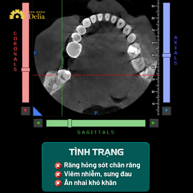 Chú Đồng gặp tình trạng răng hỏng do sót chân răng, viêm nhiễm, sưng đau khiến ăn nhai khó khăn