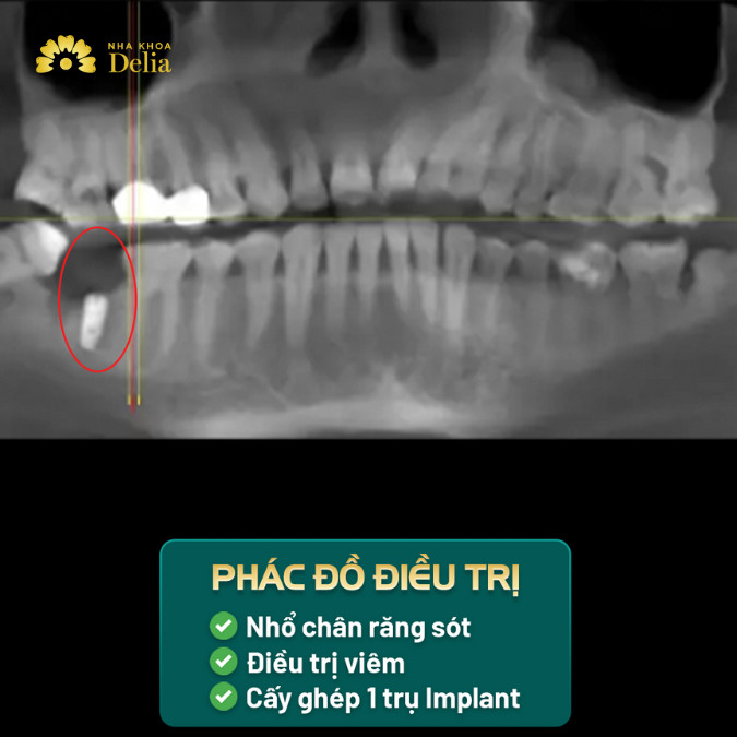 Bác sĩ lên phác đồ điều trị cho chú Đồng bao gồm nhổ chân răng còn sót lại, điều trị viêm và cấy Implant