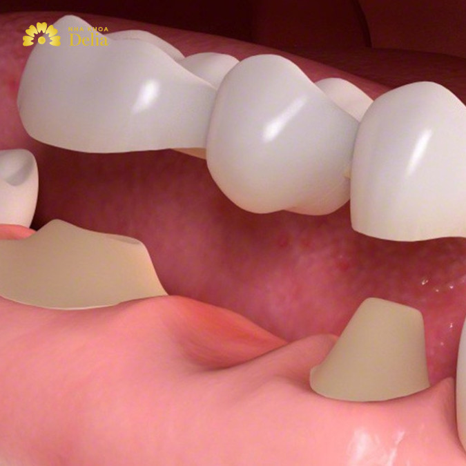 Cầu răng sứ sử dụng 2 mão sứ được gắn cố định vào hai răng thật khỏe mạnh ở hai bên vị trí răng đã mất