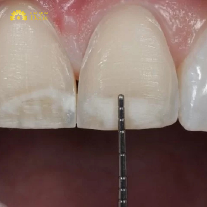 Cầu răng sứ cần mài răng nên gây xâm lấn, ảnh hưởng đến cấu trúc răng thật