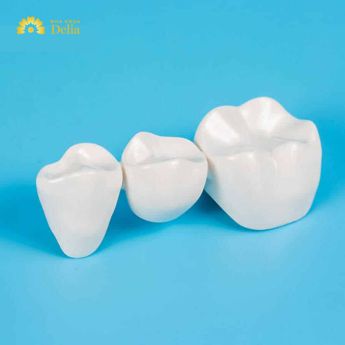 Tuổi thọ cầu răng không cao, cần thay thế sau một thời gian sử dụng